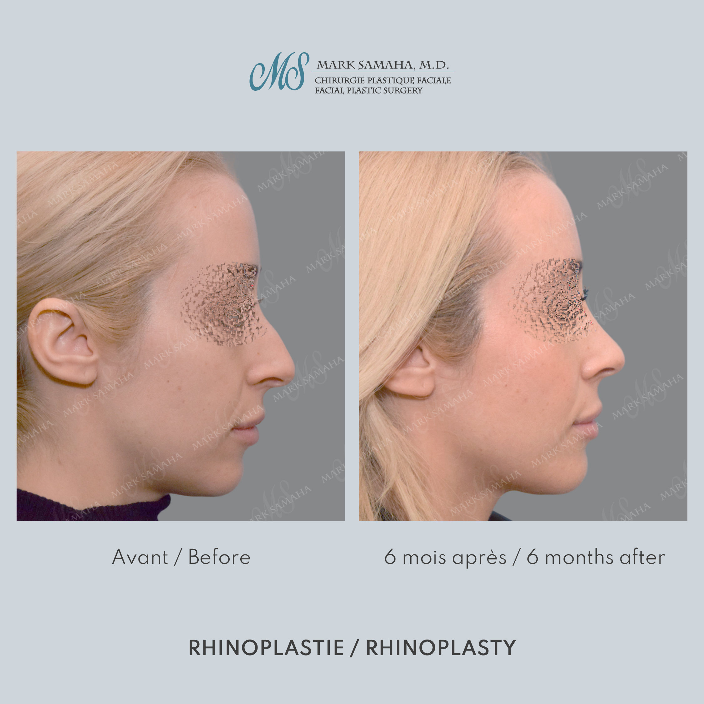 Before & After Rhinoplastie / Rhinoplasty Case 213 View #2 View in Montreal, QC