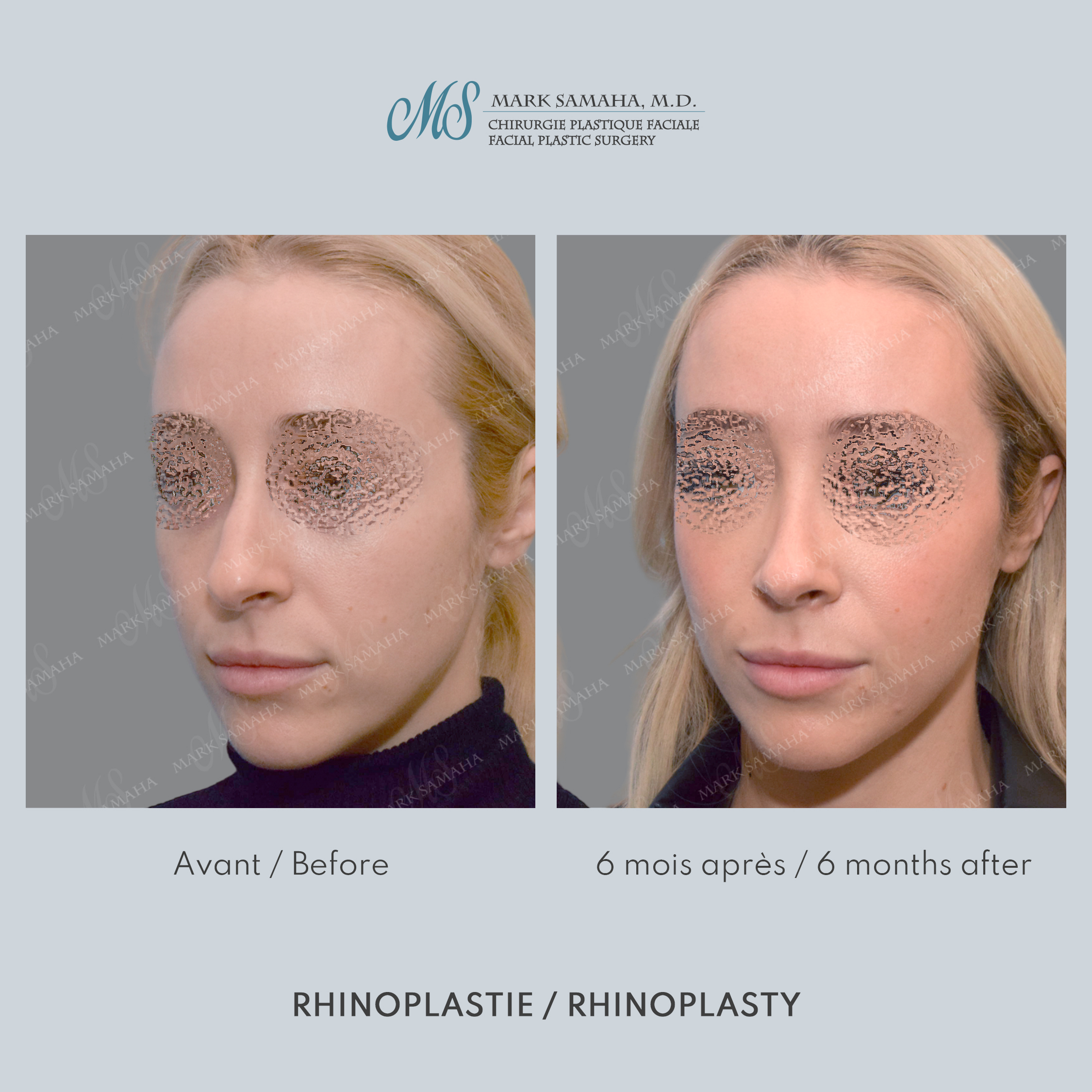 Before & After Rhinoplastie / Rhinoplasty Case 213 View #3 View in Montreal, QC
