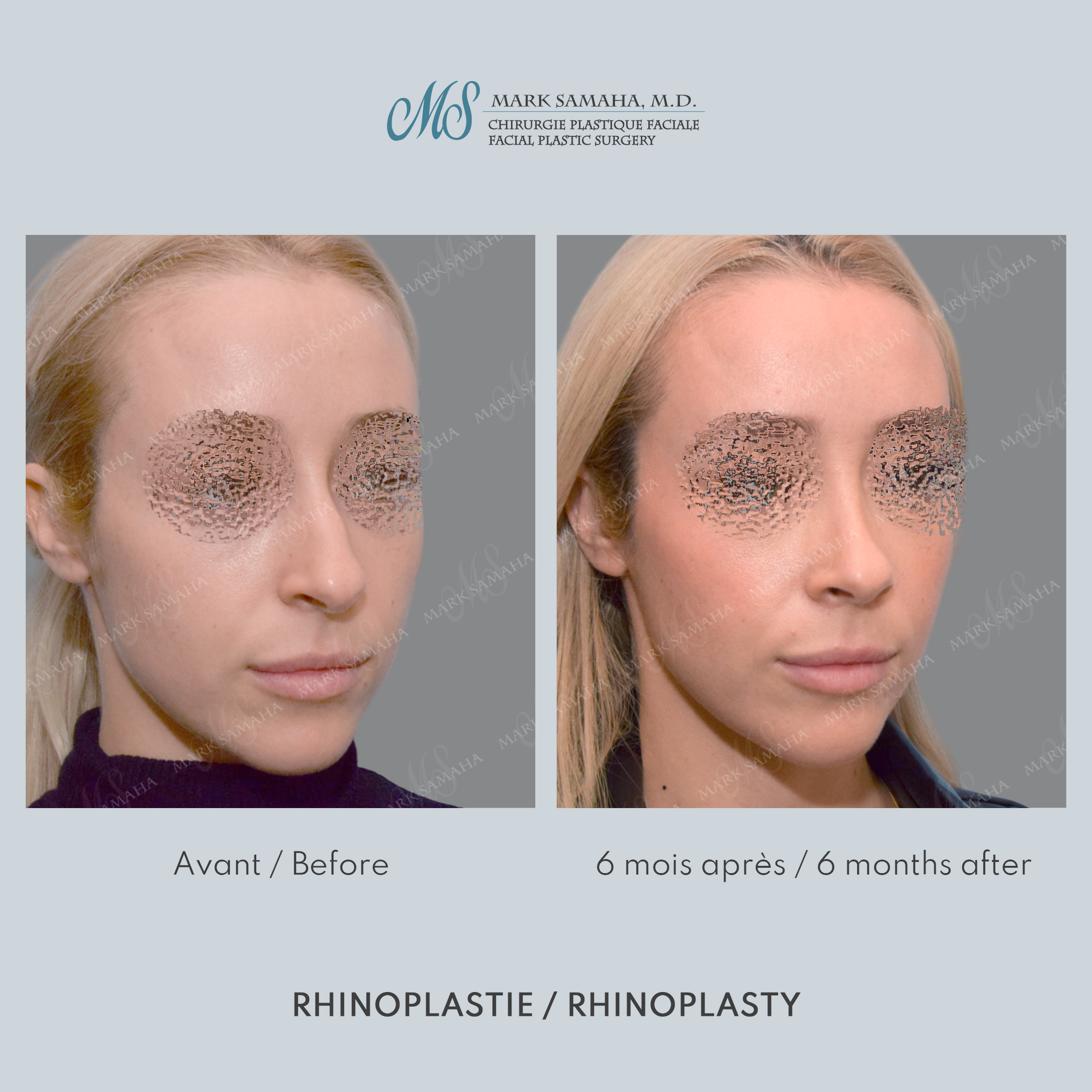 Before & After Rhinoplastie / Rhinoplasty Case 213 View #4 View in Montreal, QC