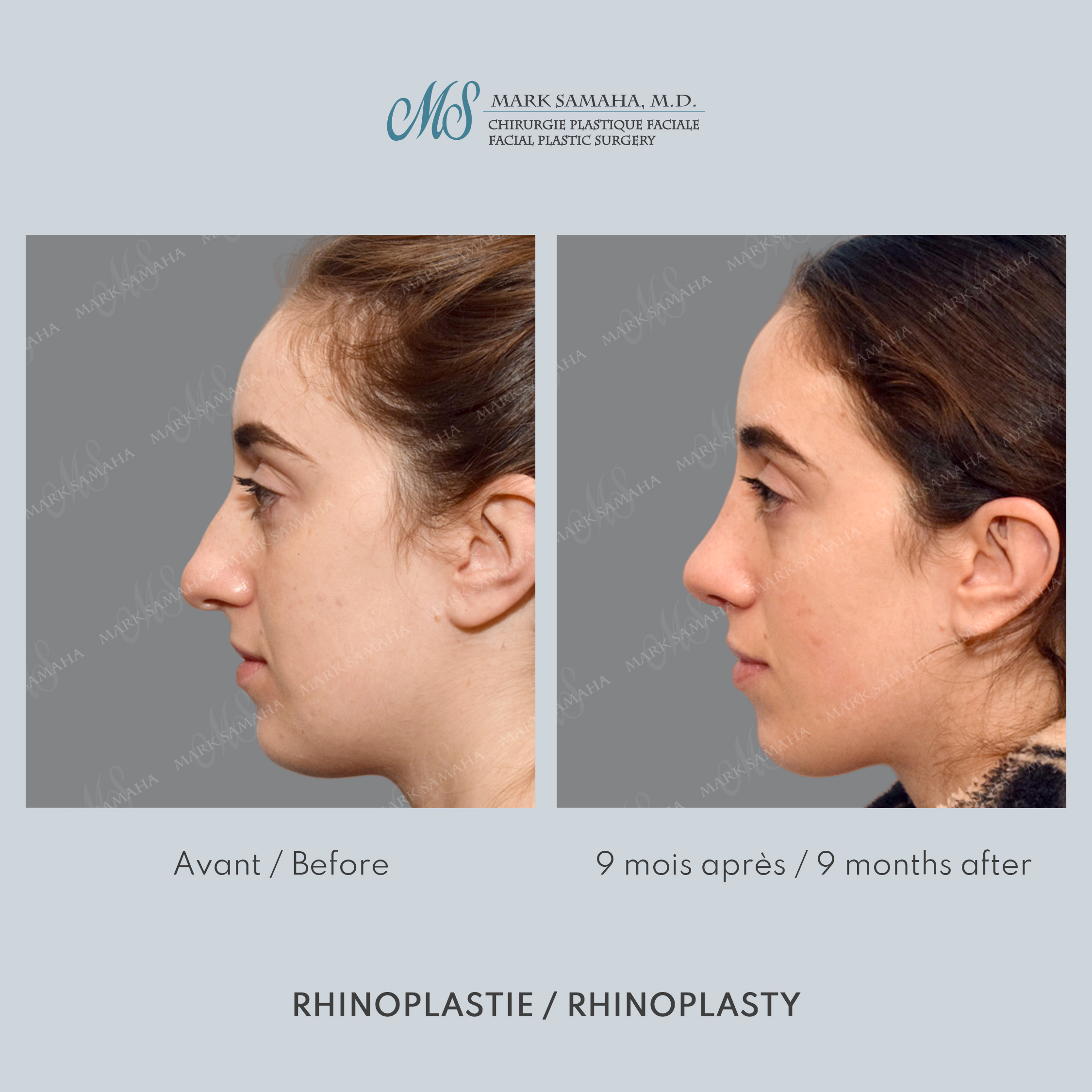 Before & After Rhinoplastie / Rhinoplasty Case 214 View #1 Detail View in Montreal, QC
