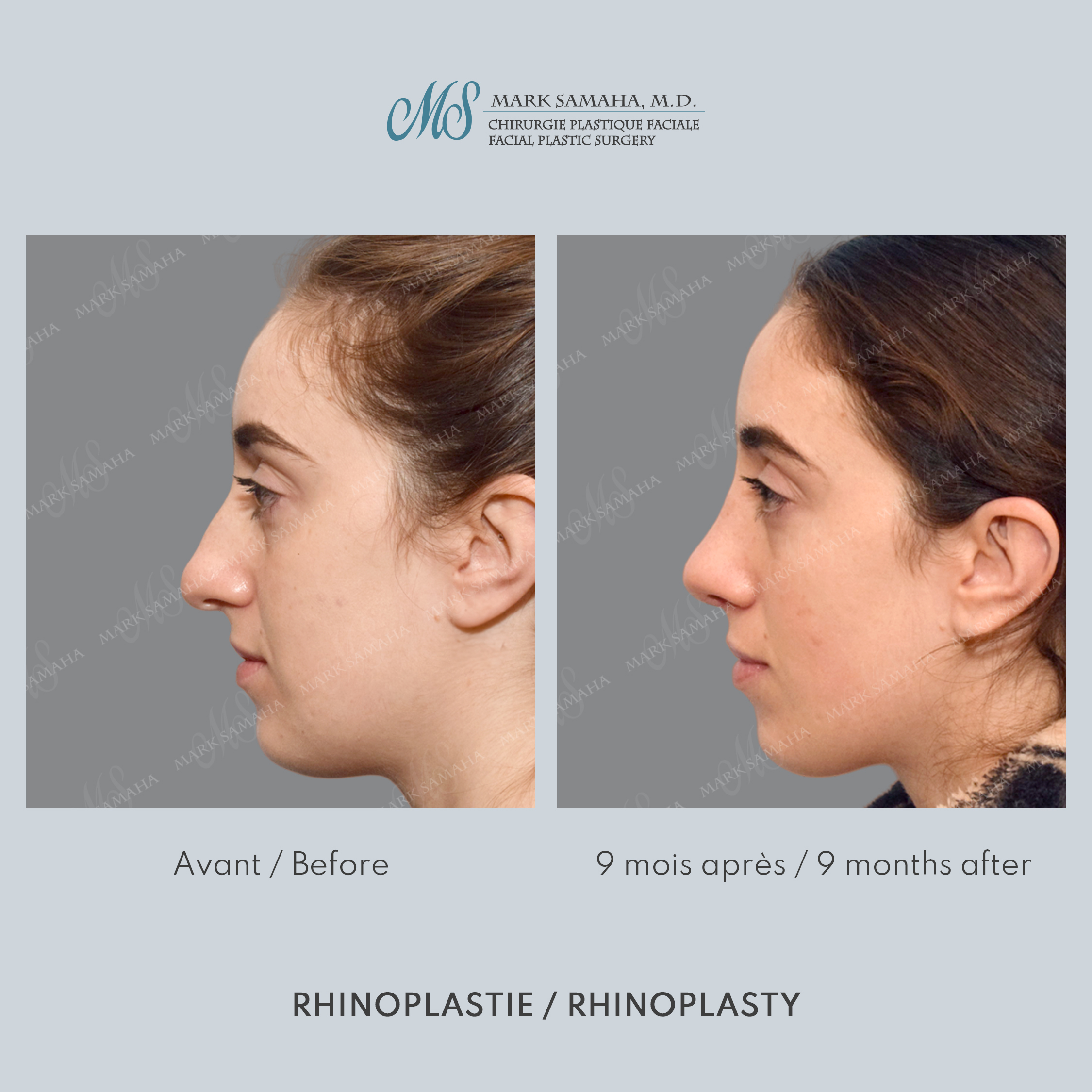 Before & After Rhinoplastie / Rhinoplasty Case 214 View #1 View in Montreal, QC