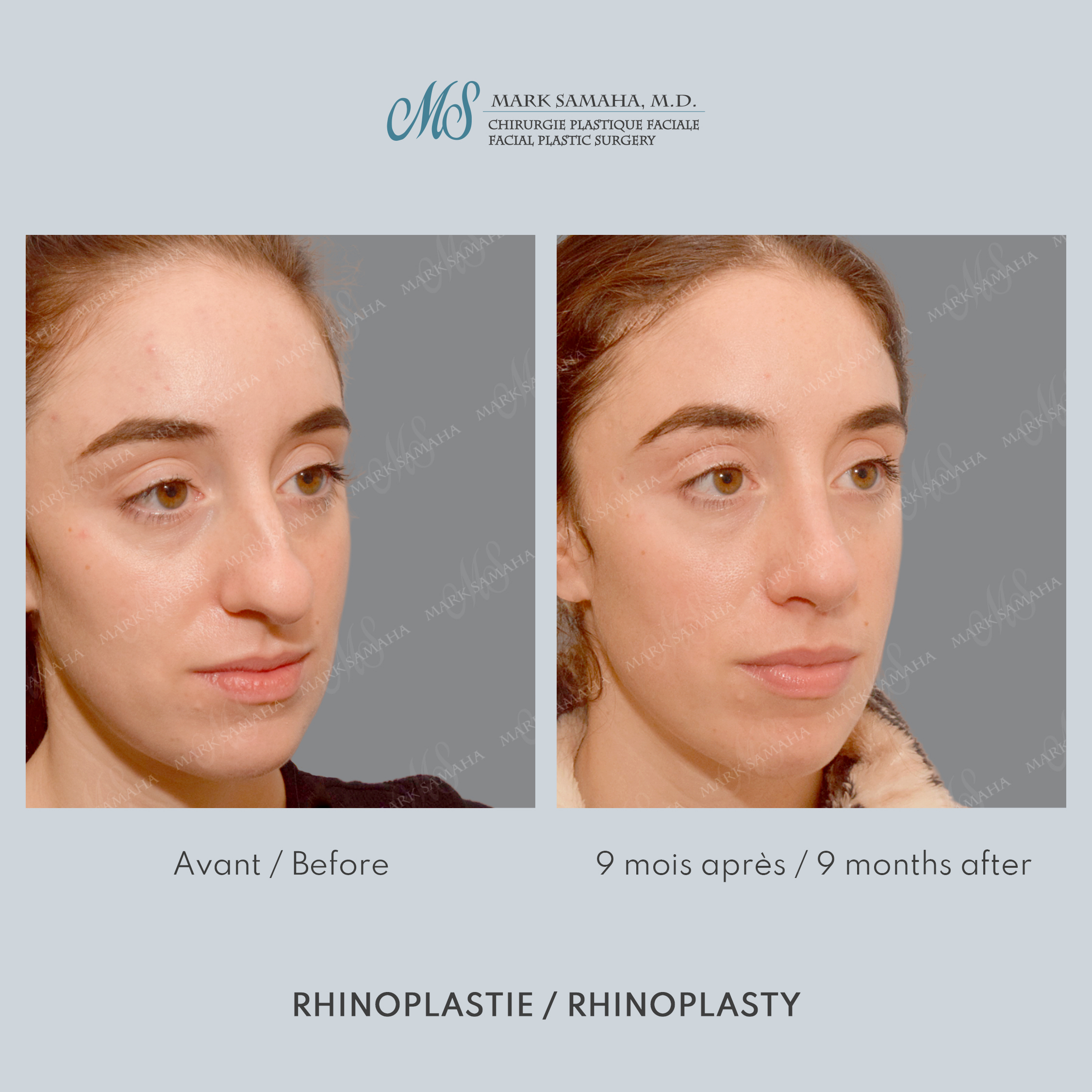 Before & After Rhinoplastie / Rhinoplasty Case 214 View #2 View in Montreal, QC