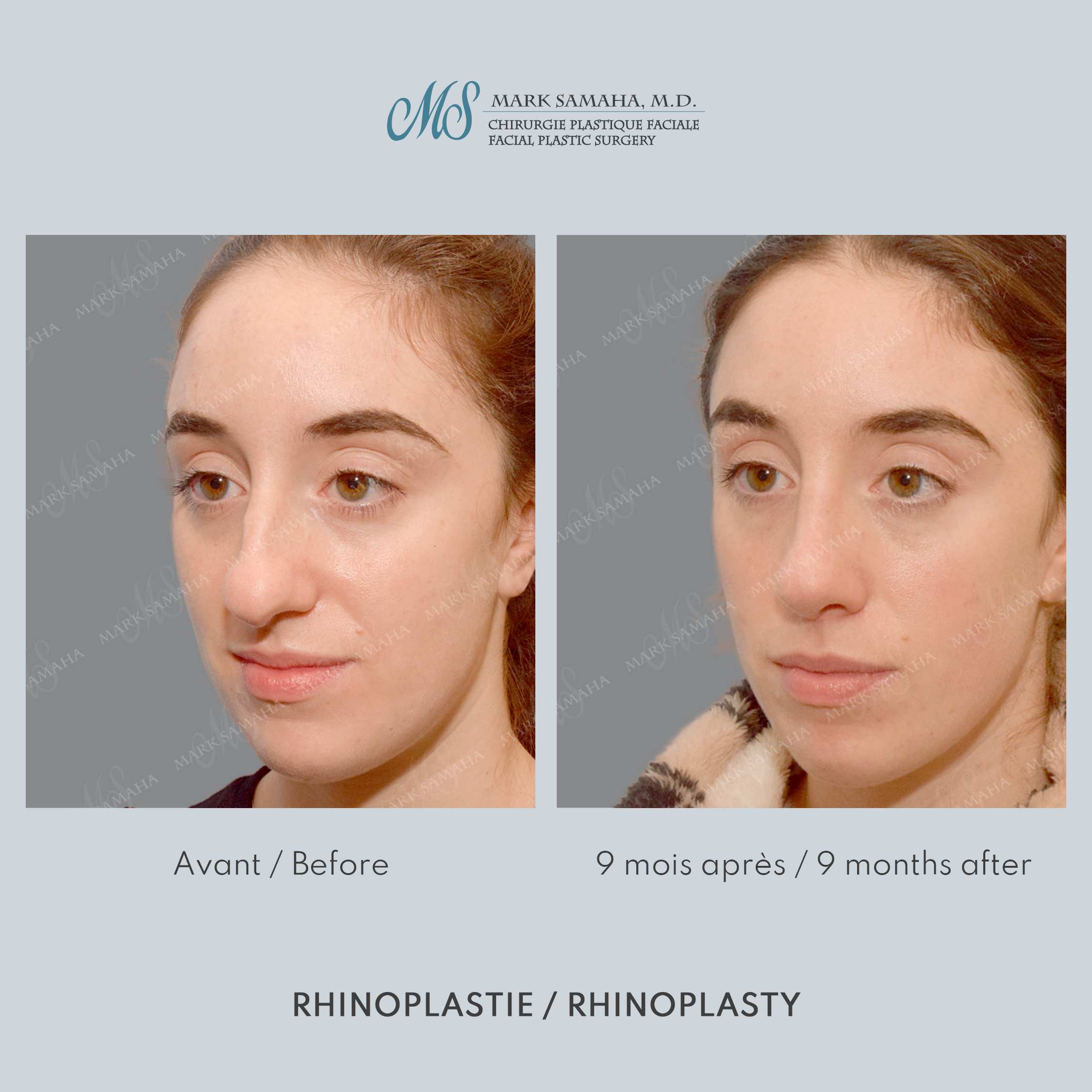 Before & After Rhinoplastie / Rhinoplasty Case 214 View #3 View in Montreal, QC