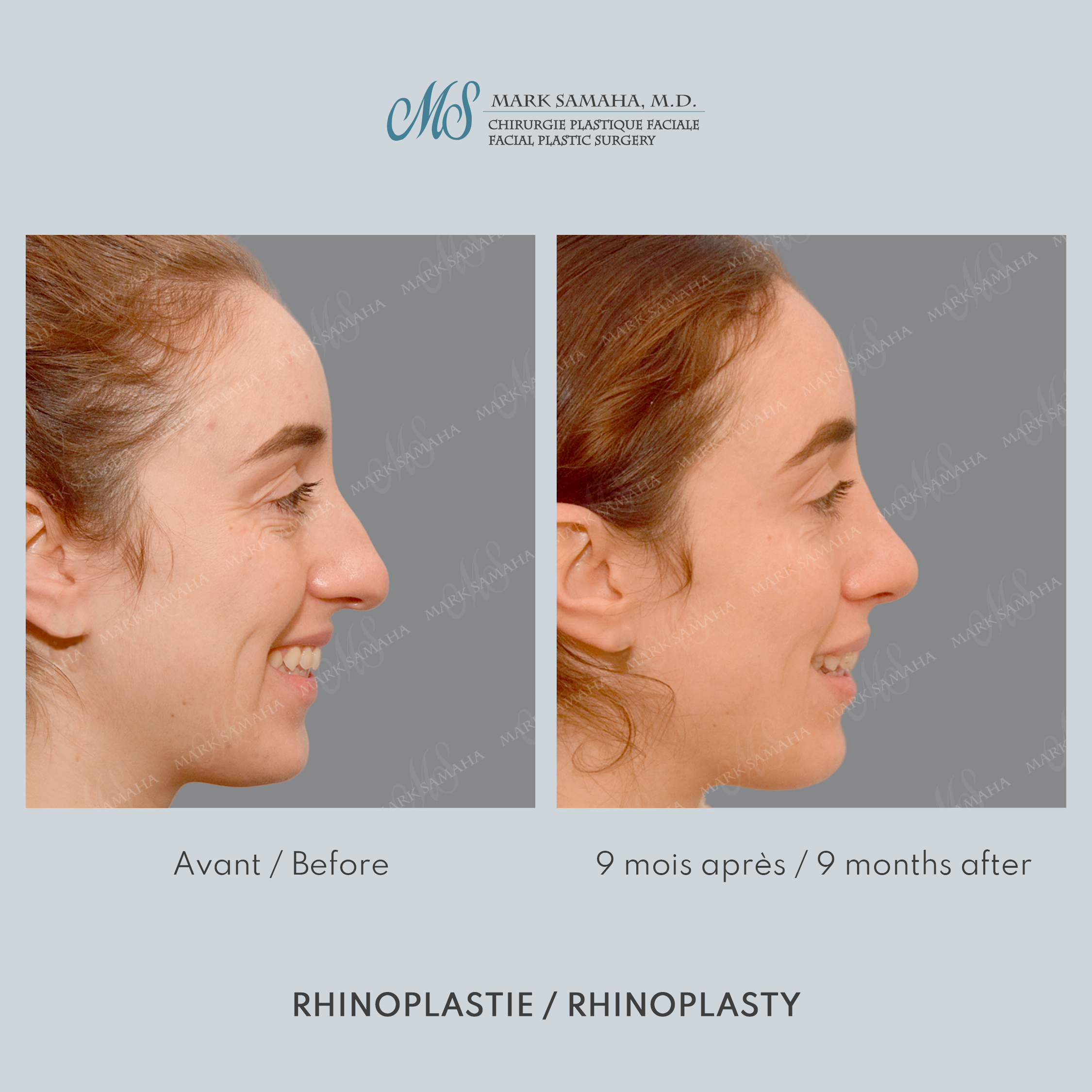 Before & After Rhinoplastie / Rhinoplasty Case 214 View #4 View in Montreal, QC