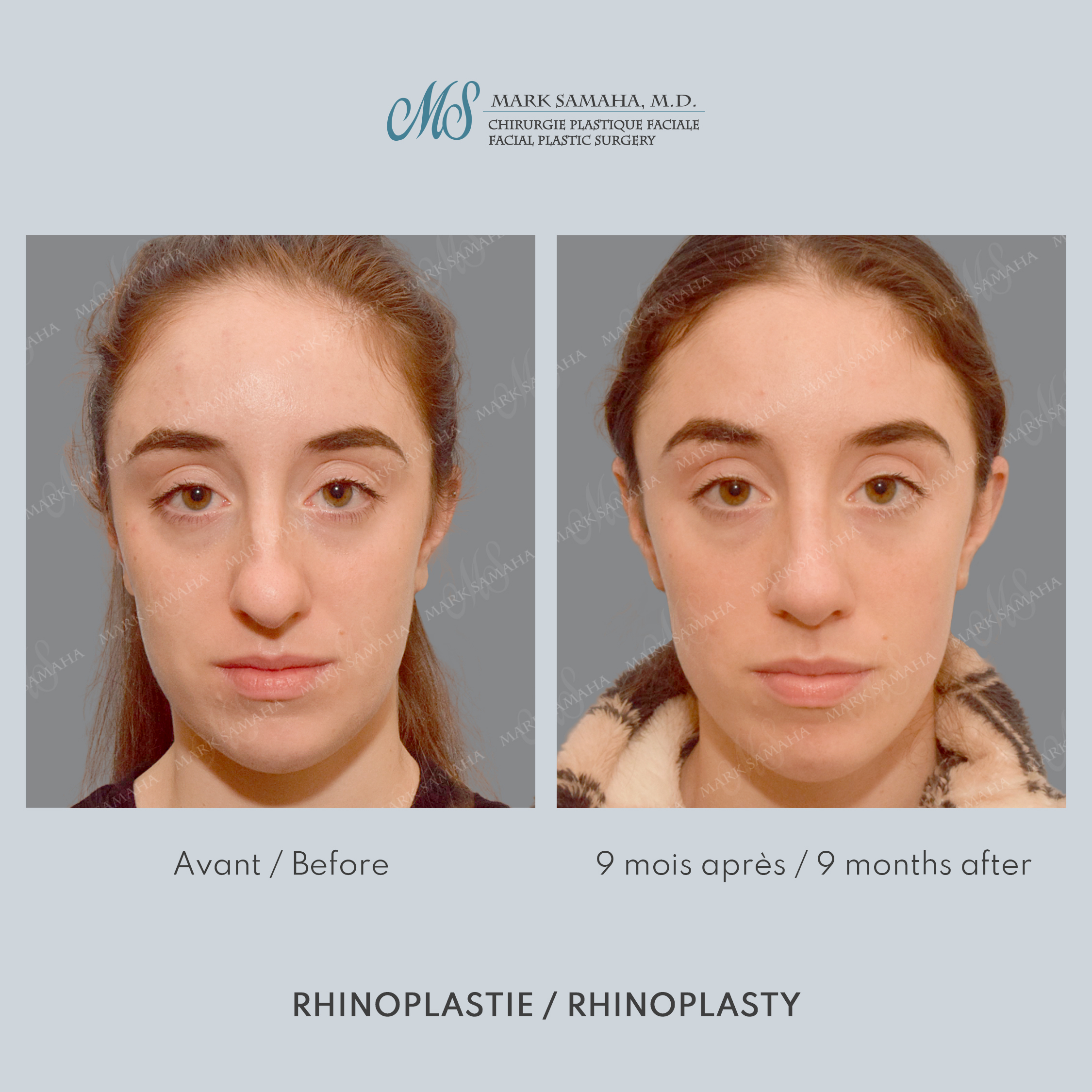 Before & After Rhinoplastie / Rhinoplasty Case 214 View #5 View in Montreal, QC