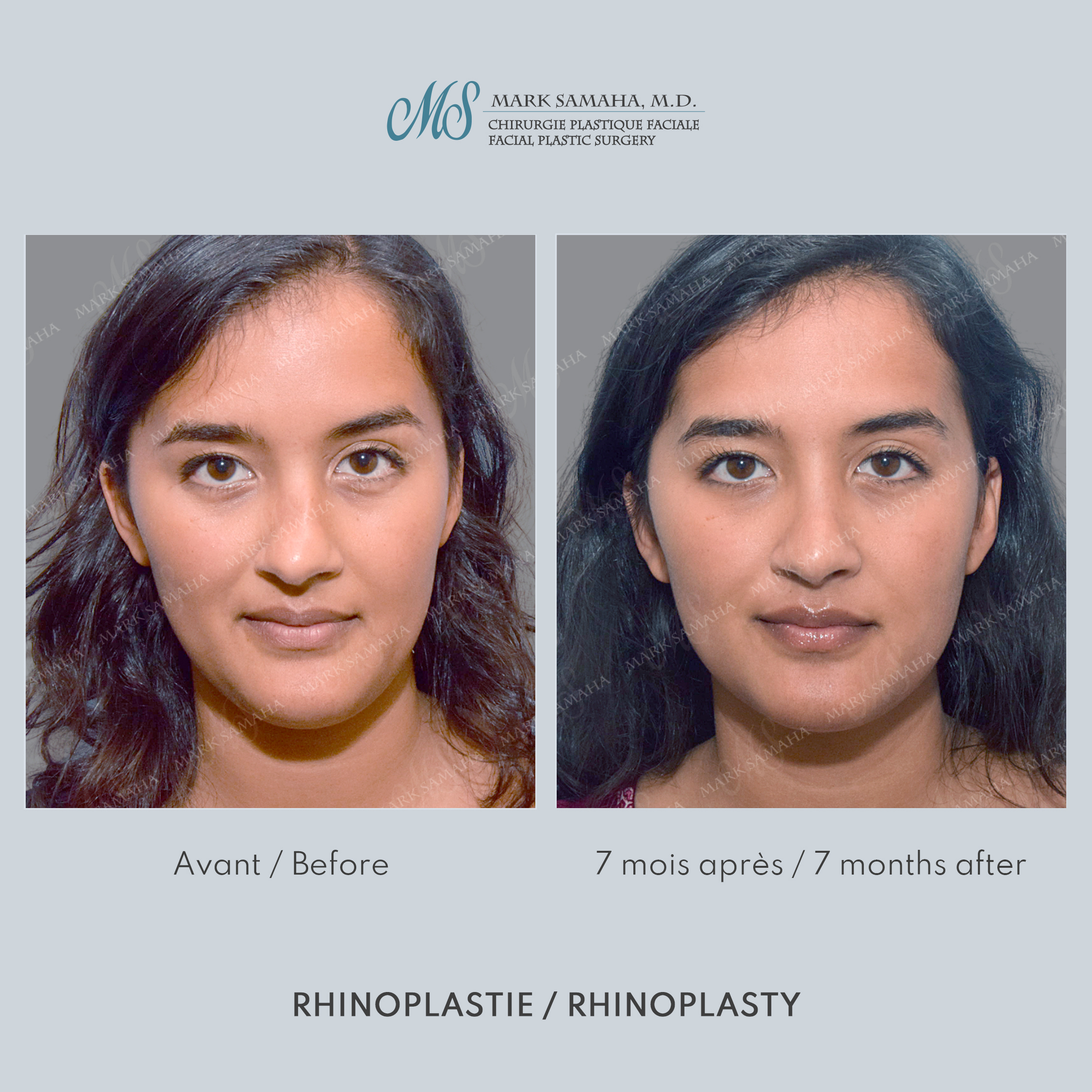 Before & After Rhinoplastie / Rhinoplasty Case 215 View #1 Detail View in Montreal, QC