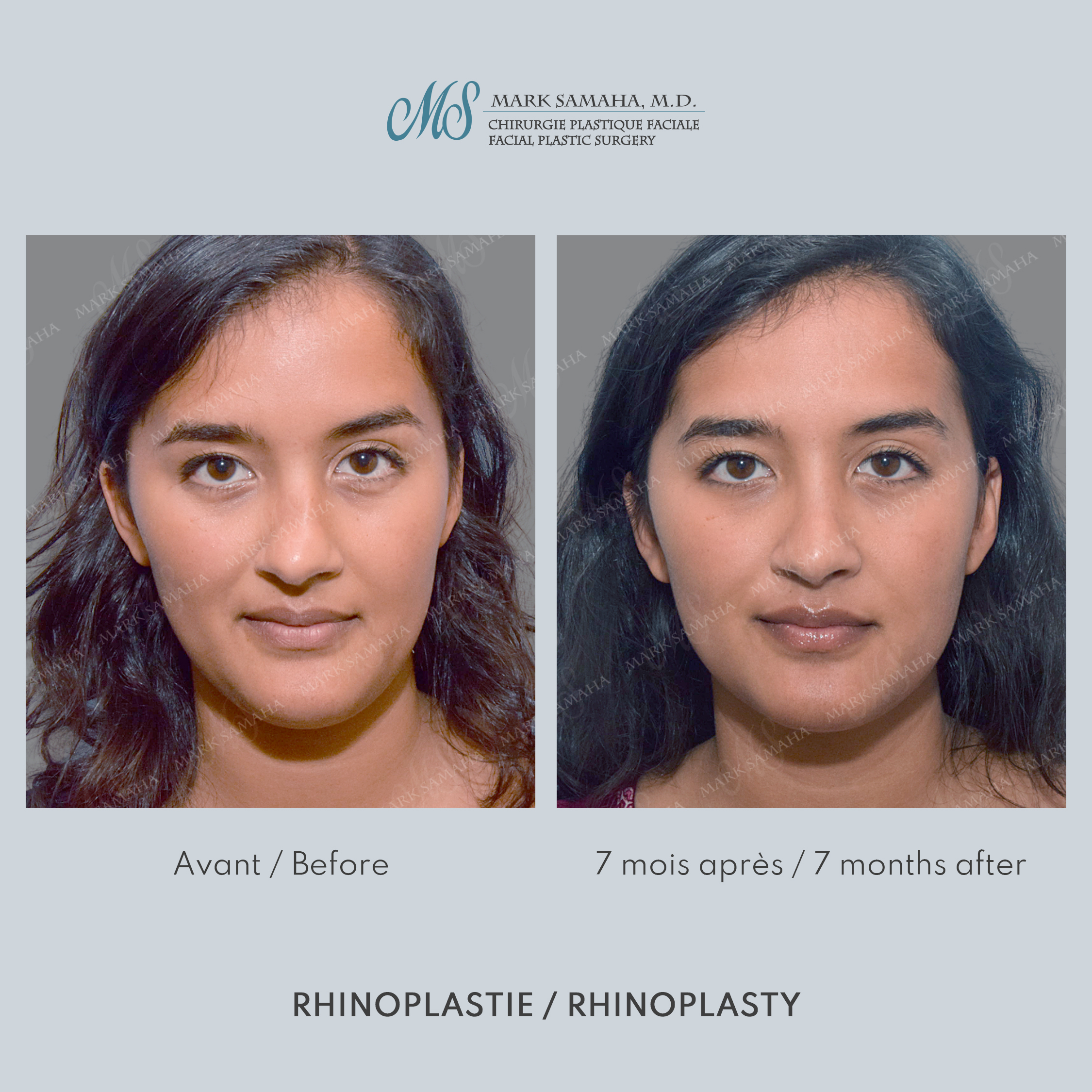 Before & After Rhinoplastie / Rhinoplasty Case 215 View #1 View in Montreal, QC