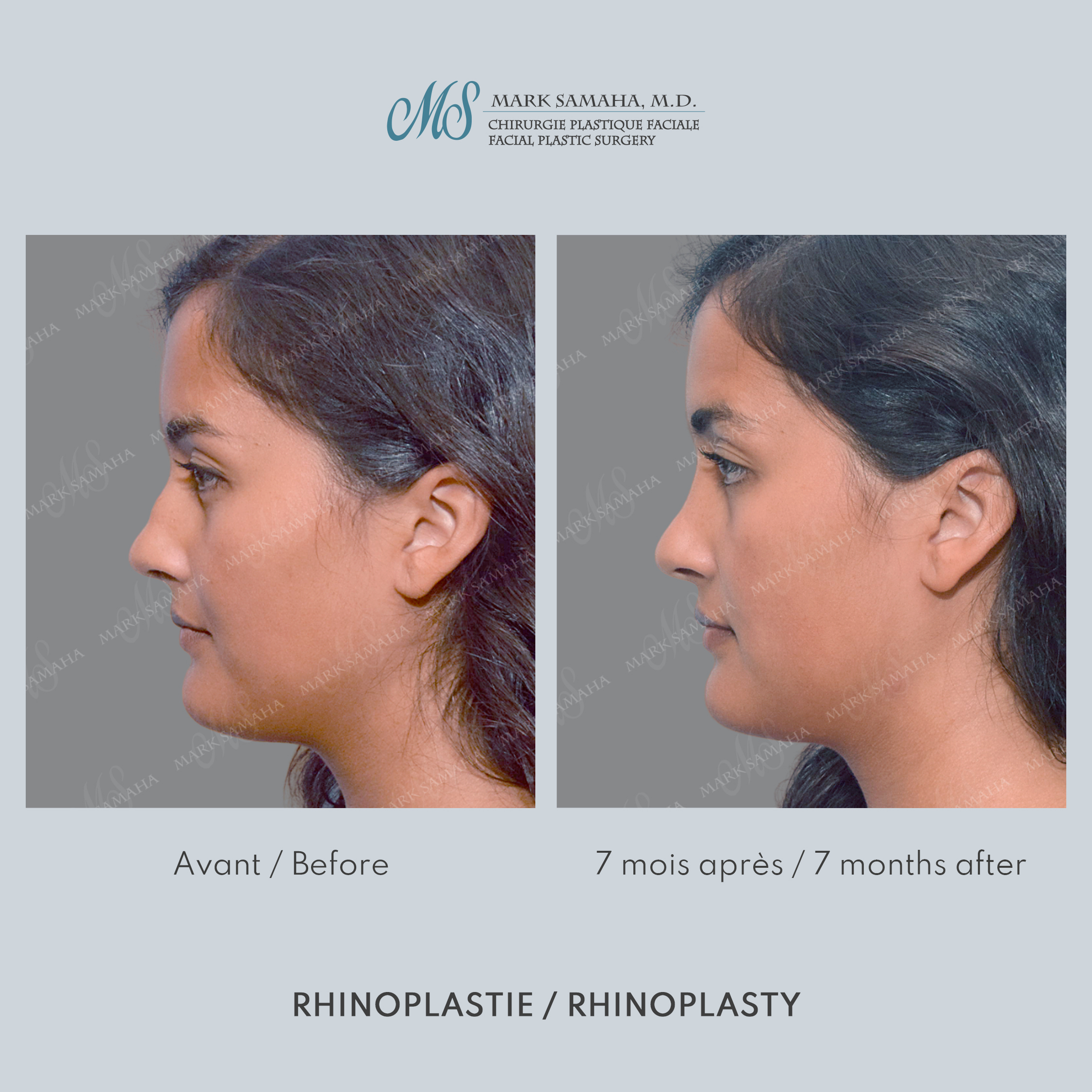 Before & After Rhinoplastie / Rhinoplasty Case 215 View #2 View in Montreal, QC