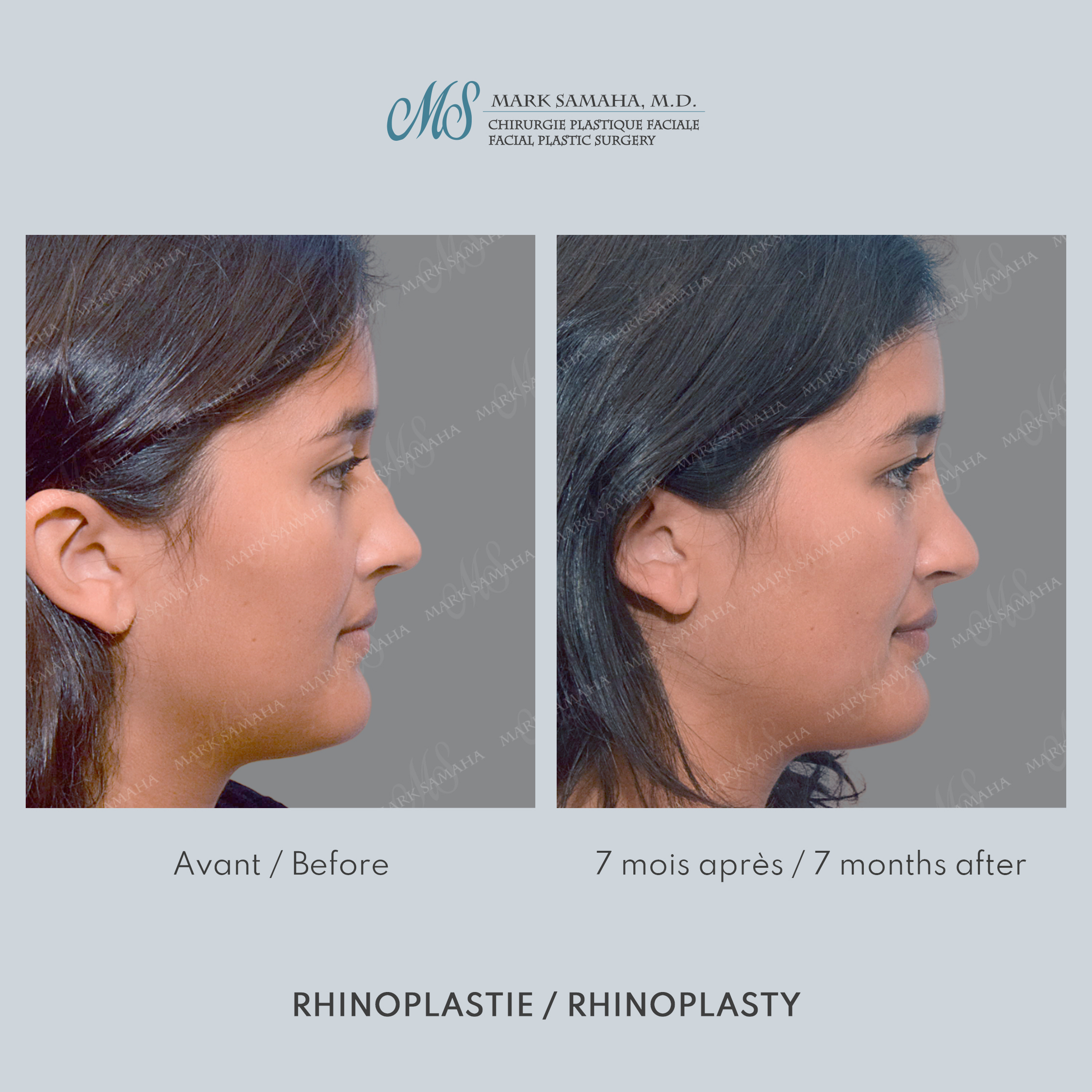 Before & After Rhinoplastie / Rhinoplasty Case 215 View #3 View in Montreal, QC