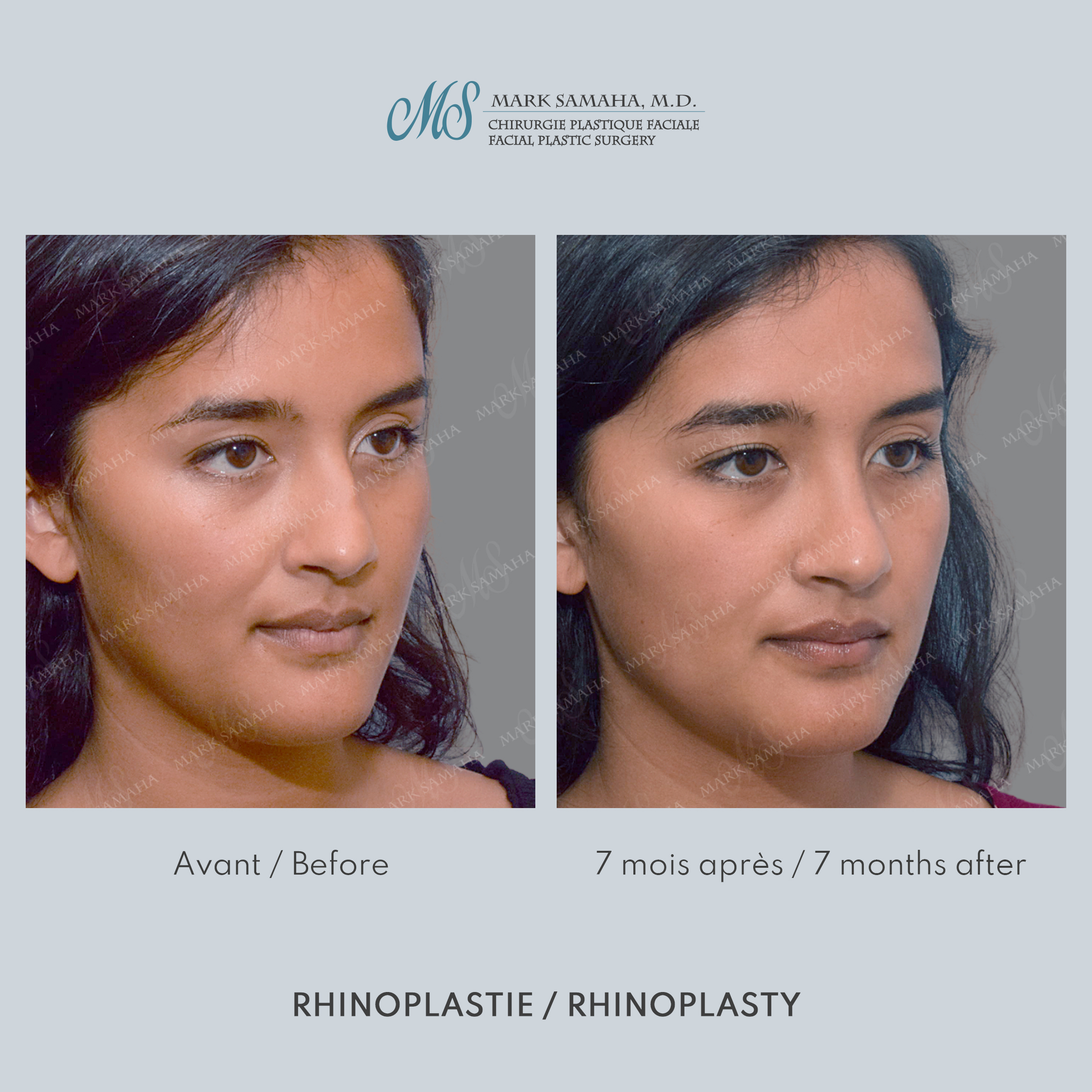 Before & After Rhinoplastie / Rhinoplasty Case 215 View #4 View in Montreal, QC