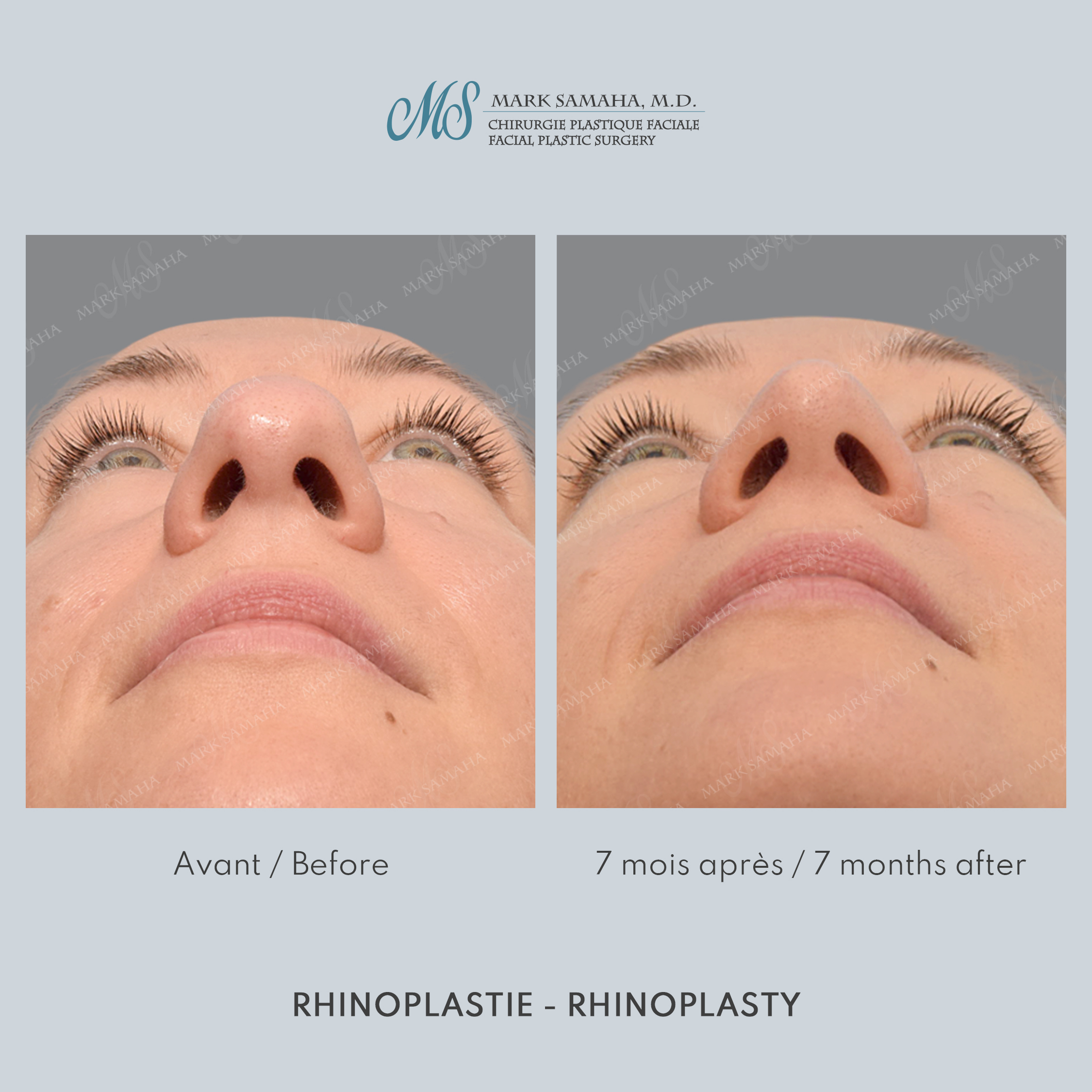 Before & After Rhinoplastie / Rhinoplasty Case 216 View #2 View in Montreal, QC