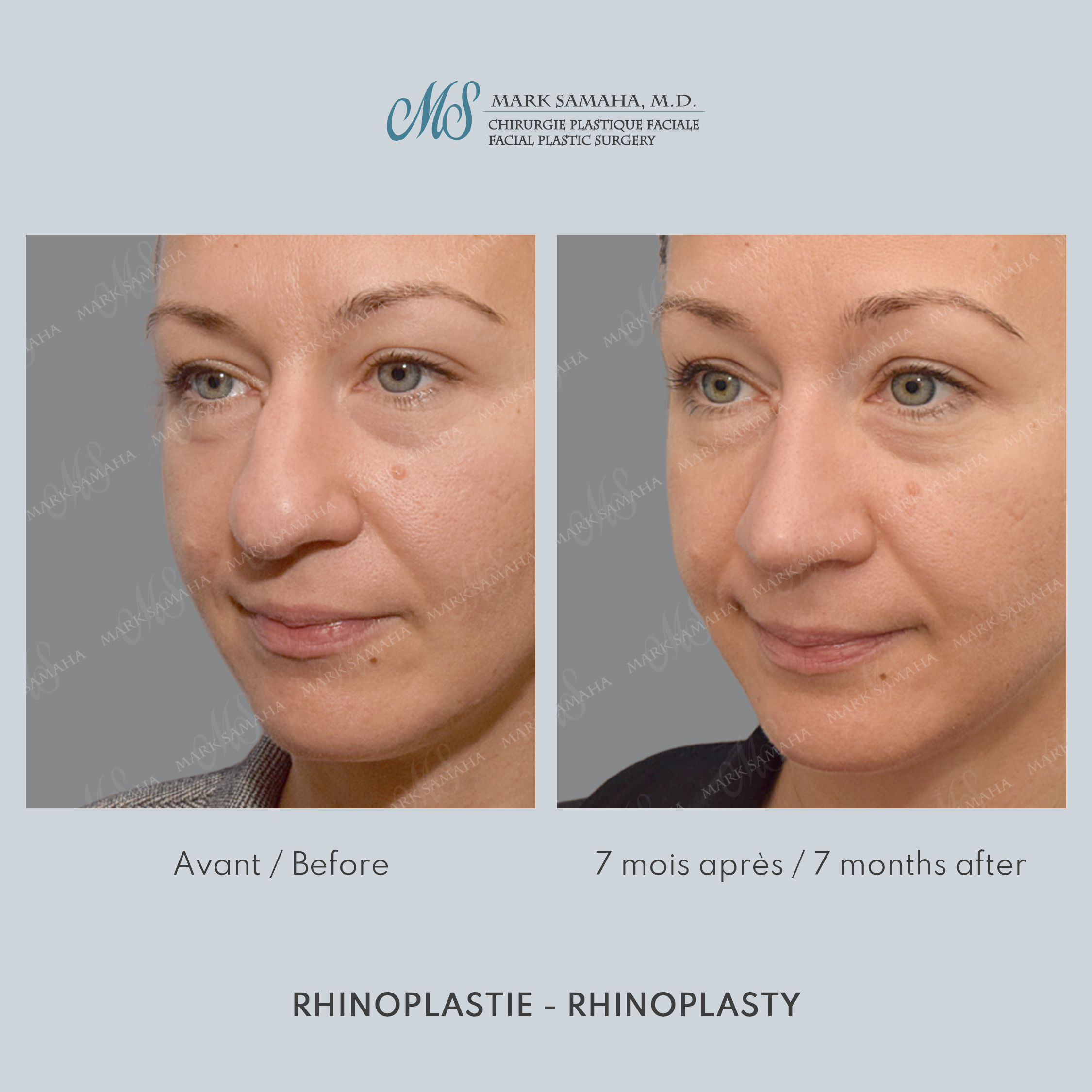 Before & After Rhinoplastie / Rhinoplasty Case 216 View #3 View in Montreal, QC