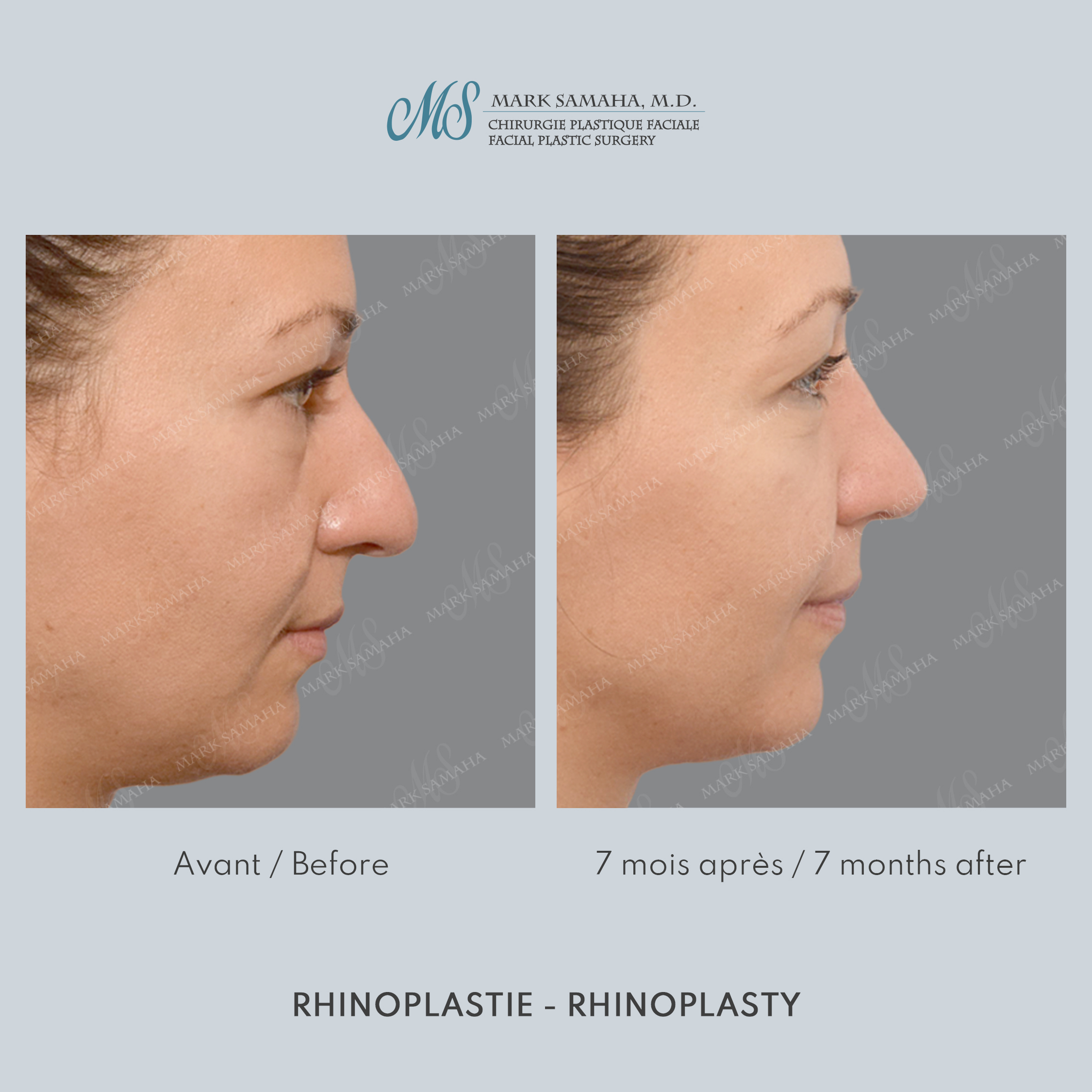 Before & After Rhinoplastie / Rhinoplasty Case 216 View #4 View in Montreal, QC
