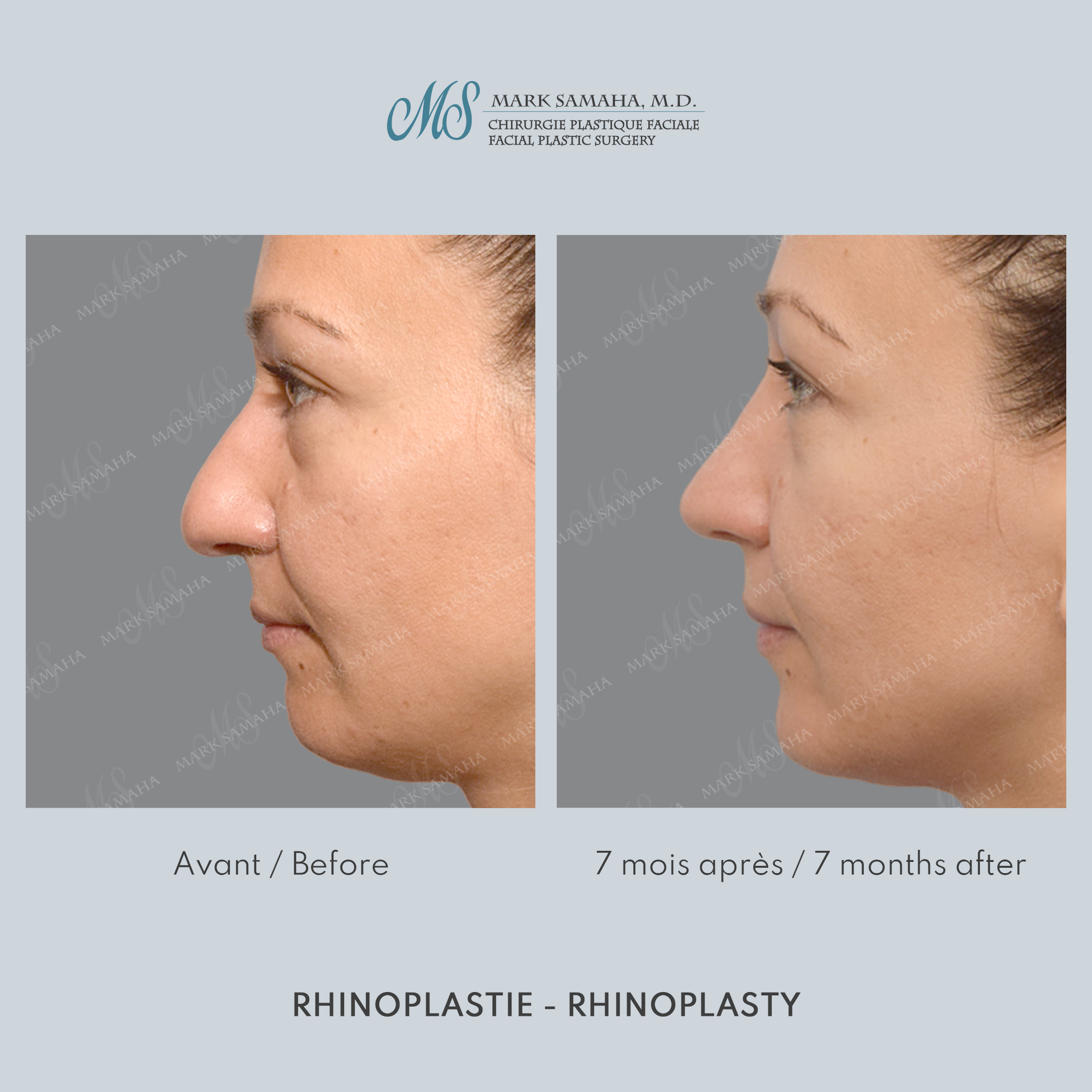 Before & After Rhinoplastie / Rhinoplasty Case 216 View #5 View in Montreal, QC