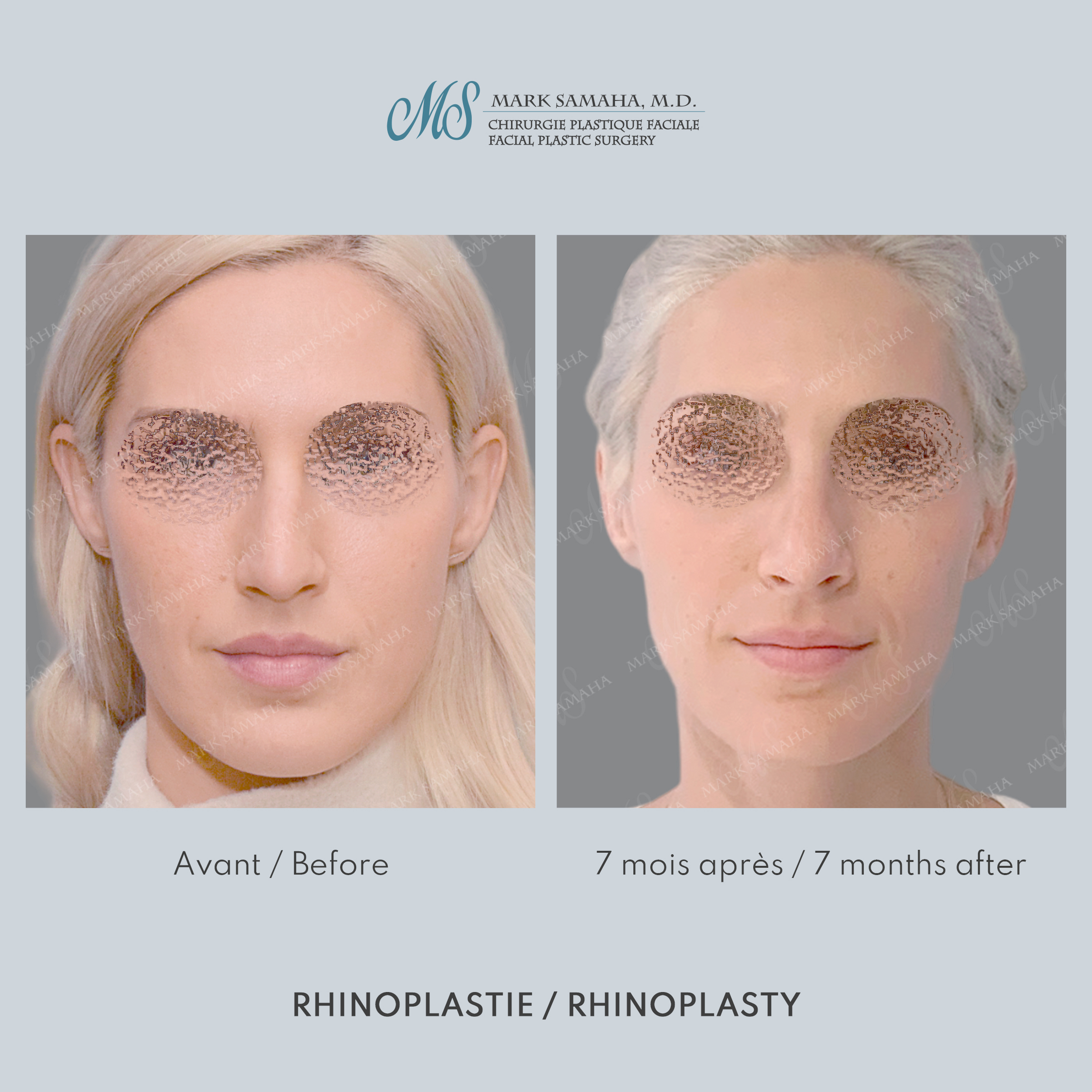 Before & After Rhinoplastie / Rhinoplasty Case 217 View #1 View in Montreal, QC
