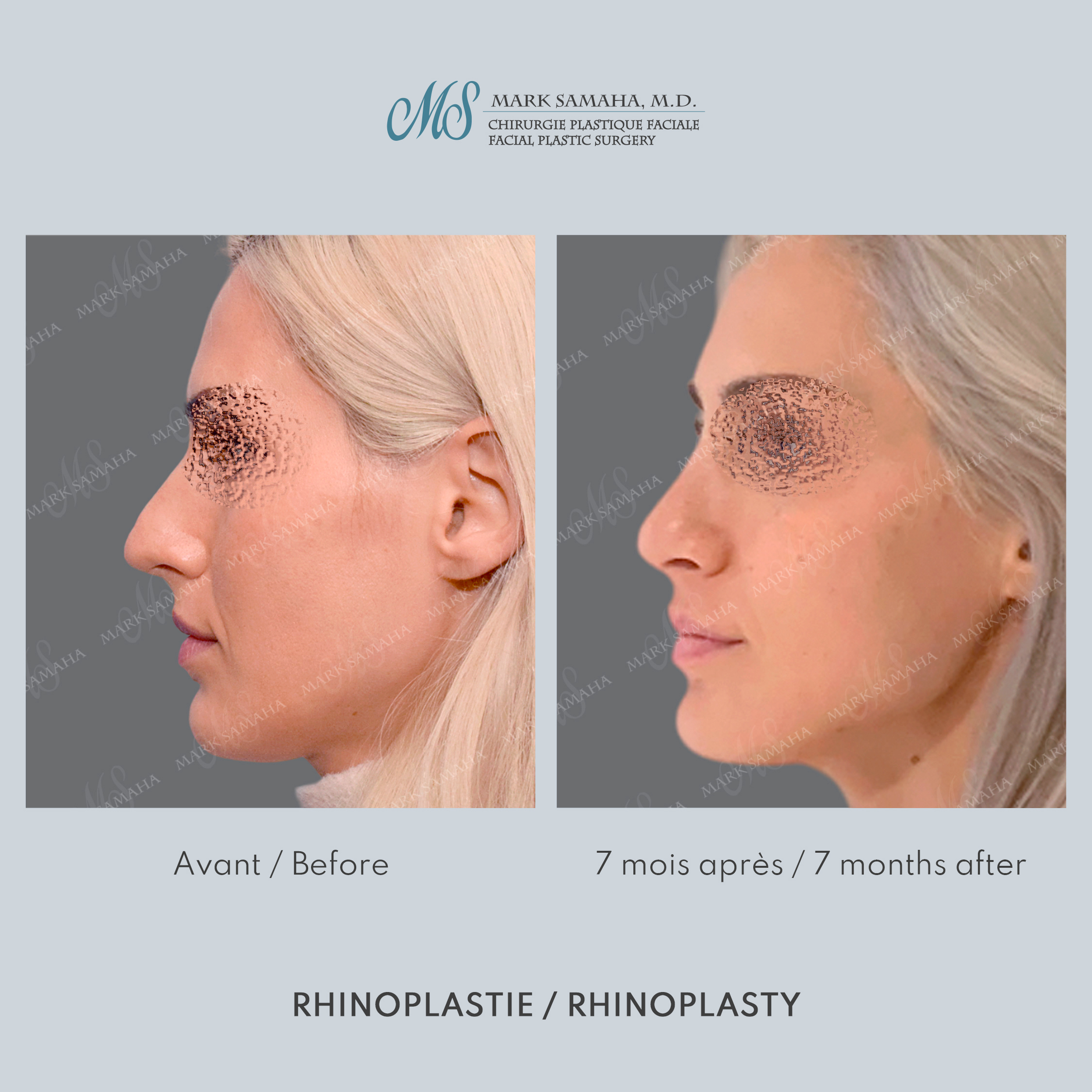 Before & After Rhinoplastie / Rhinoplasty Case 217 View #2 Detail View in Montreal, QC