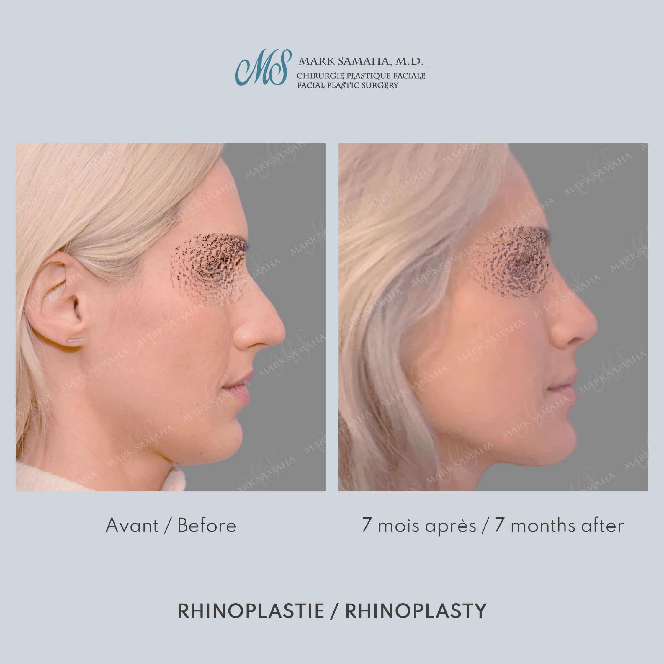 Before & After Rhinoplastie / Rhinoplasty Case 217 View #3 View in Montreal, QC